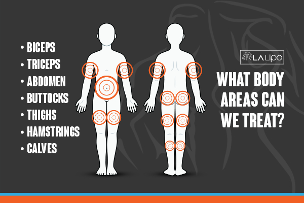 Graphic to show areas you can have LA-EMS Body Sculpting Chelsea treatment.